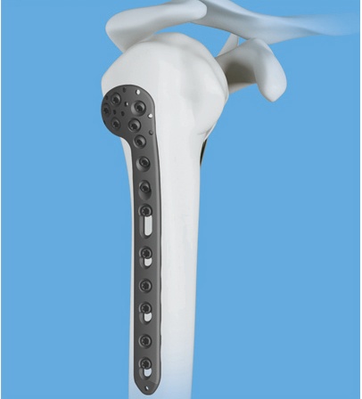 Proximal Humeral Greater Tubercle Locking Plate