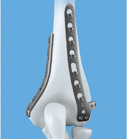 Distal Lateral Dorsal Humeral Locking Plate(Buttress)