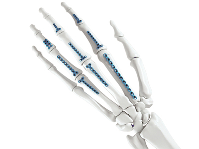 微型接骨板系統