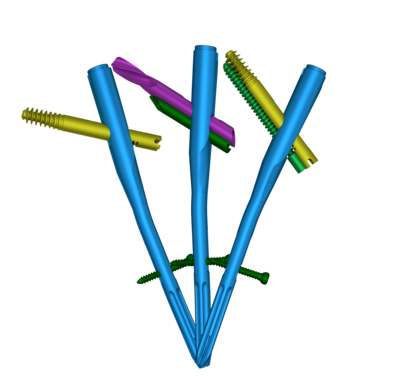 Tri-Max股骨近端三合一髓內釘系統