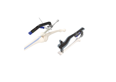 CanETN-Ⅱ髕上技術脛骨髓內釘系統