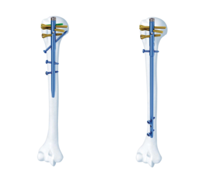 肱骨近端多维髓内钉系统