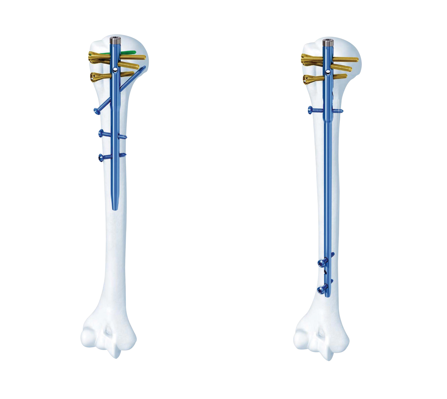 肱骨近端多维髓内钉系统