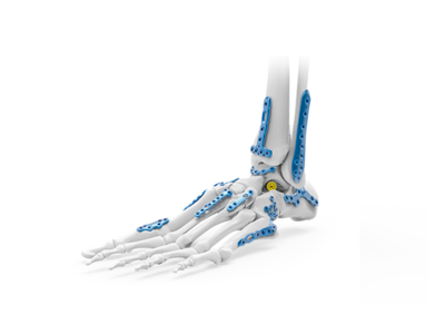 CanFAR足踝綜合解決方案