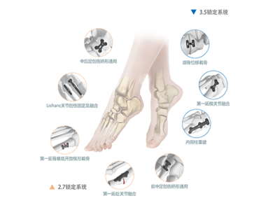CanFAR足踝重建鎖定接骨板系統