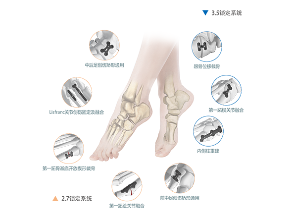 CanFAR足踝重建锁定接骨板系统