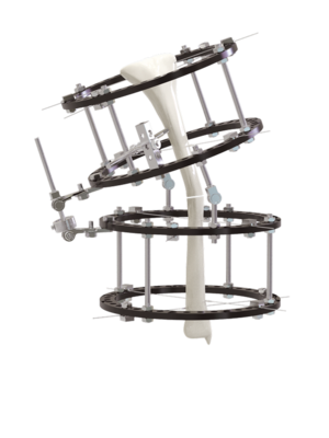 llizarov環形外架