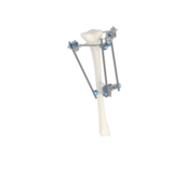 組合式外固定支架