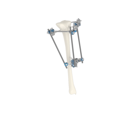 組合式外固定支架