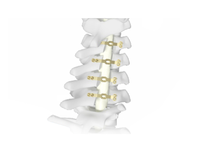 CanPCP椎板固定系統